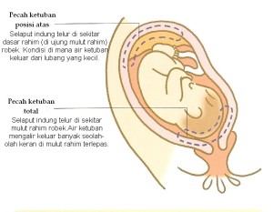 6 Ciri Ciri Air Ketuban Pecah Merembes Hamil Co Id