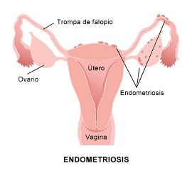 gejala endometriosis