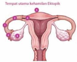 gejala kehamilan ektopik